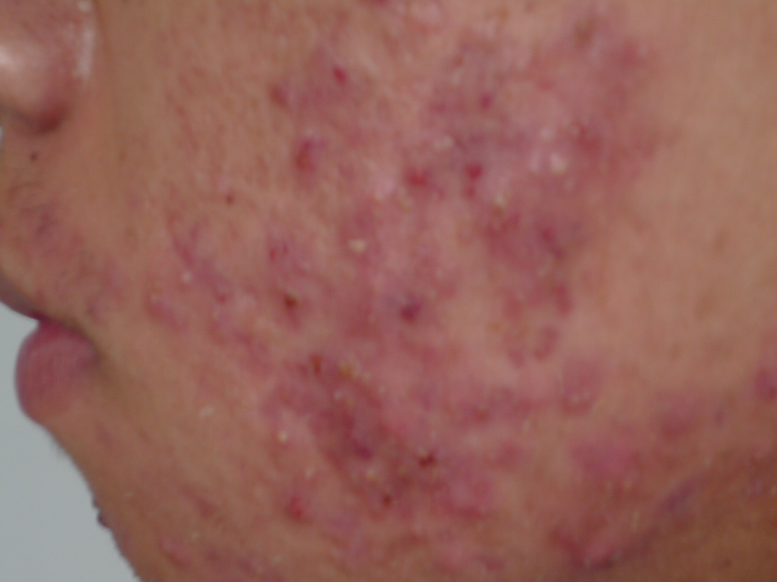 皮肤损坏青春痘可分为8种类型