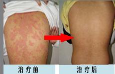 脸上的银屑病要怎么护理