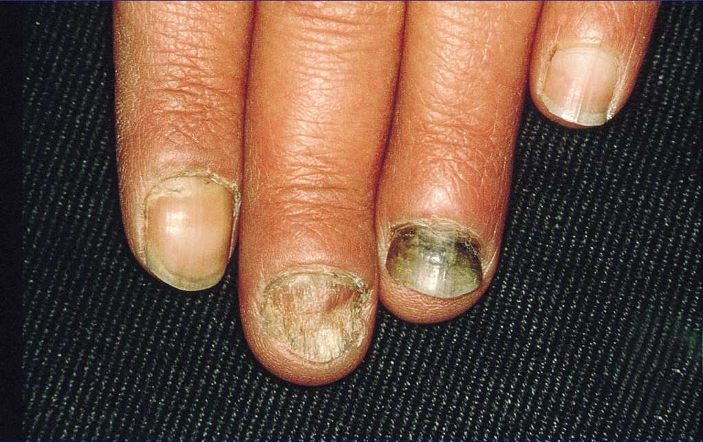 怎样预防灰指甲的复发？