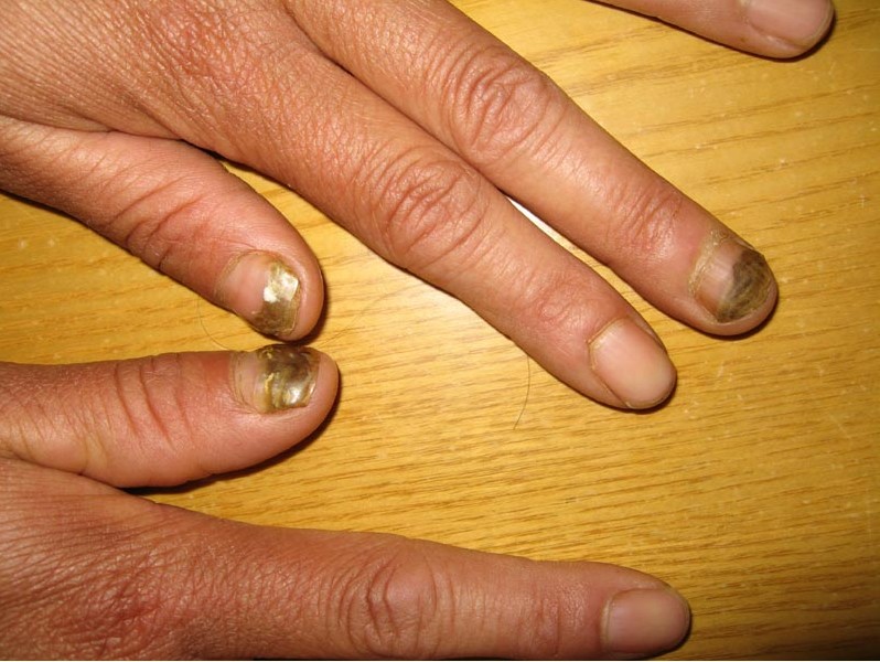 不同创伤引起的灰指甲症状