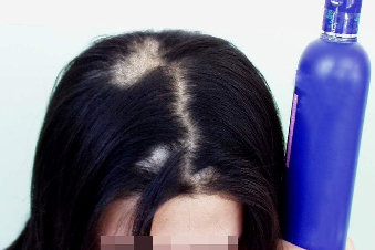 经常染发会导致脱发吗