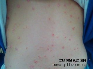 皮肤红痒肿痛脱皮持续是不是牛皮癣