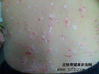 牛皮癣患者注意缓解精神方面的压力
