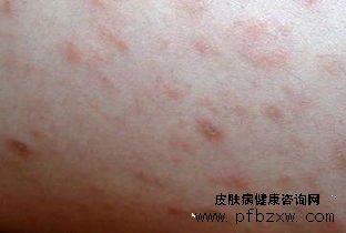 牛皮癣和过敏如何准确区分