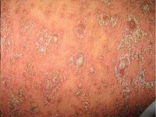 牛皮癣患者夏天洗澡需要特别注意什么