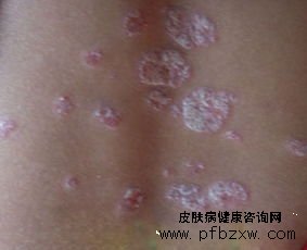 起水痘会增加牛皮癣发病的概率吗