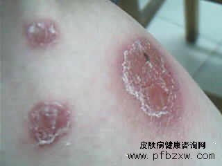 牛皮癣好了又复发怎么做