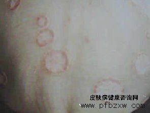 怀孕的牛皮癣患者孕期如何调理