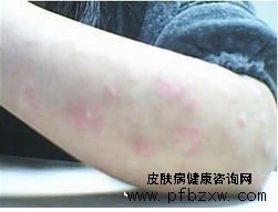 牛皮癣能完全治好的方法都有什么