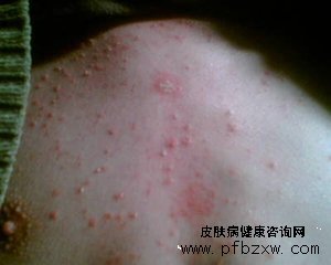 牛皮癣求治心切,雪上加霜