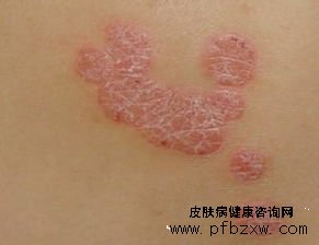 孕期可以治疗牛皮癣吗