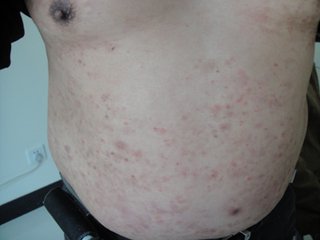 哪些治疗牛皮癣的中成药有效