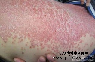 在医院治疗过牛皮癣但一直没有恢复