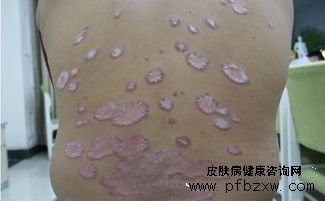 牛皮癣是真菌感染的吗