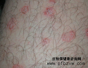 手部牛皮癣治疗有什么特效药吗