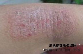 牛皮癣具体是怎么引起的