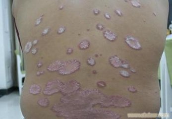 科学治疗牛皮癣能避免遗传吗