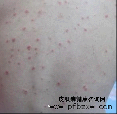牛皮癣发病全身起皮怎么办