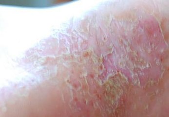 红皮型牛皮癣还可以治疗吗
