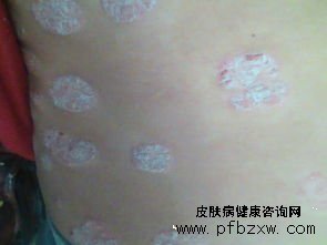 牛皮癣用什么药治疗才对症