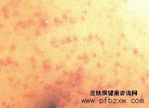 牛皮癣影响夫妻感情
