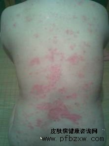 怎么样科学规范的治疗患者的牛皮癣