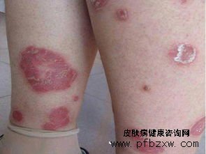 牛皮癣患处干燥瘙痒怎么处理