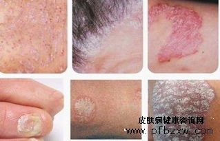 诱发牛皮癣发病加重的因素