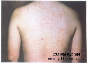 牛皮癣软膏有副作用吗