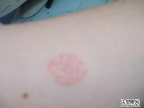 关注寻常型牛皮癣发病初期的症状