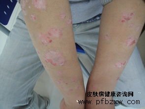 牛皮癣治愈后留下了疤痕怎么办