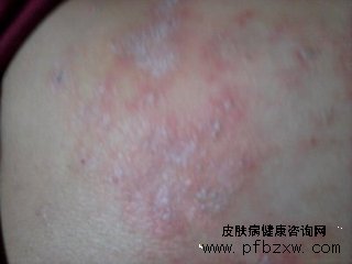 牛皮癣的绿色治疗方法