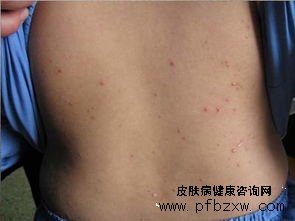 什么药物治疗牛皮癣能有效的防止复发