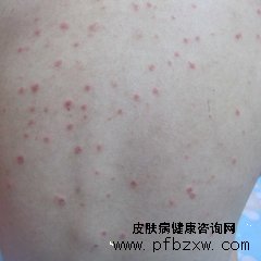 牛皮癣的发病都是寻常型的吗