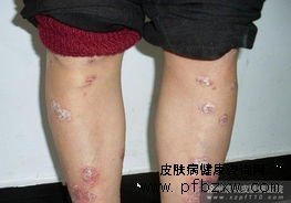 外伤引起牛皮癣疾病的原因