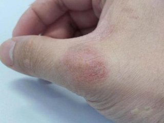 多年顽固牛皮癣还有根治的可能性吗