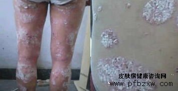 关节型牛皮癣会影响患者的视力吗