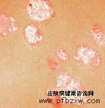 社会因素对牛皮癣患者疾病的影响