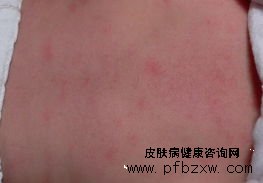 牛皮癣突然出现溃疡怎么处理