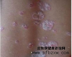 牛皮癣患者能用牛奶护肤吗