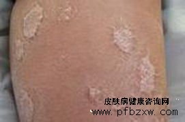 重症牛皮癣患者如何更好的治疗