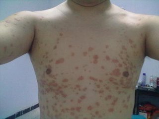 简单介绍得了牛皮癣不能吃的食物