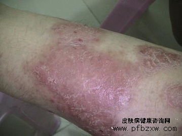 补充足够的水分能预防牛皮癣疾病吗