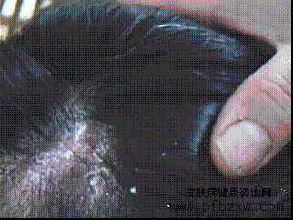 牛皮癣患者为什么不能使用西药治疗